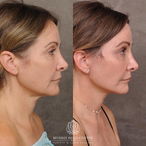 Beverly Hills Center Female Patient Before and After Auralyft, Eyes & Brows, Face & Neck