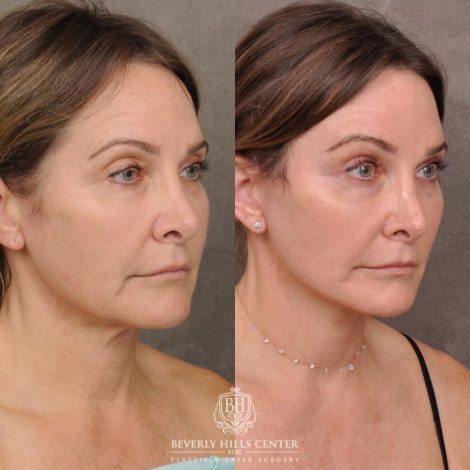 Beverly Hills Center Female Patient Before and After Auralyft, Eyes & Brows, Face & Neck