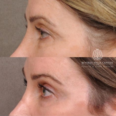 Beverly Hills Center Female Patient Before and After Auralyft, Eyes & Brows, Face & Neck