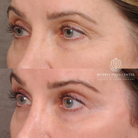 Beverly Hills Center Female Patient Before and After Auralyft, Eyes & Brows, Face & Neck