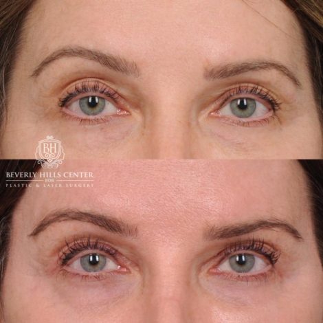 Beverly Hills Center Female Patient Before and After Auralyft, Eyes & Brows, Face & Neck