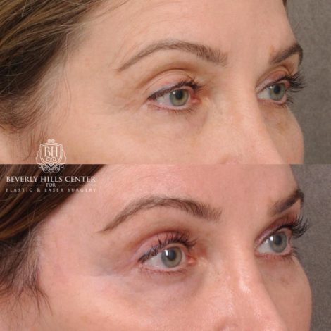 Beverly Hills Center Female Patient Before and After Auralyft, Eyes & Brows, Face & Neck