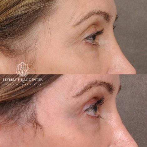 Beverly Hills Center Female Patient Before and After Auralyft, Eyes & Brows, Face & Neck