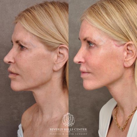 Beverly Hills Center Female Patient Before and After Auralyft, Eyes & Brows, Face & Neck