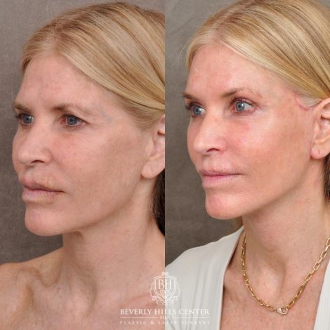 Beverly Hills Center Female Patient Before and After Auralyft, Eyes & Brows, Face & Neck