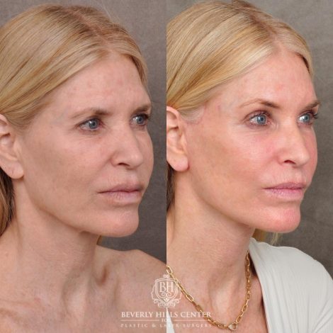 Beverly Hills Center Female Patient Before and After Auralyft, Eyes & Brows, Face & Neck