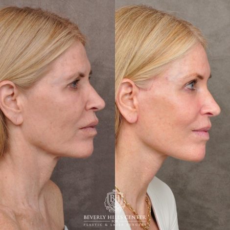 Beverly Hills Center Female Patient Before and After Auralyft, Eyes & Brows, Face & Neck