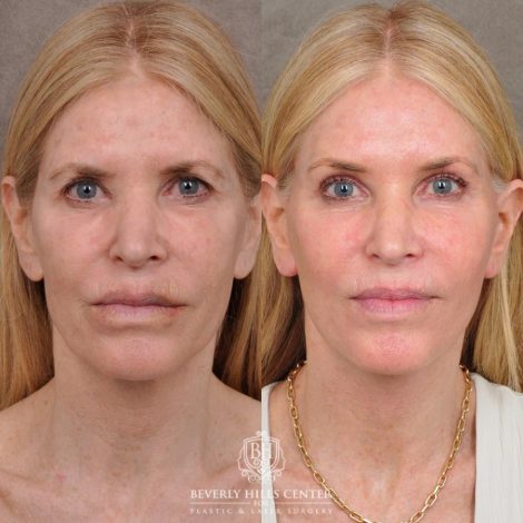 Beverly Hills Center Female Patient Before and After Auralyft, Eyes & Brows, Face & Neck