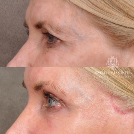 Beverly Hills Center Female Patient Before and After Auralyft, Eyes & Brows, Face & Neck