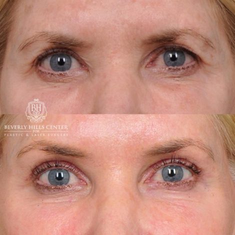 Beverly Hills Center Female Patient Before and After Auralyft, Eyes & Brows, Face & Neck