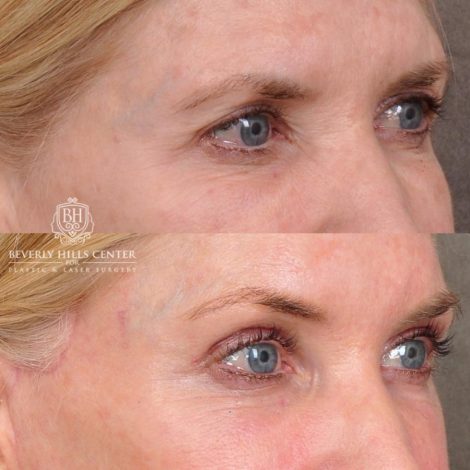 Beverly Hills Center Female Patient Before and After Auralyft, Eyes & Brows, Face & Neck