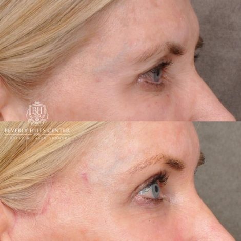 Beverly Hills Center Female Patient Before and After Auralyft, Eyes & Brows, Face & Neck