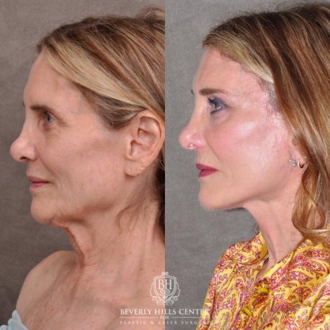 Beverly Hills Center Female Patient Before and After Auralyft, Eyes & Brows, Face & Neck