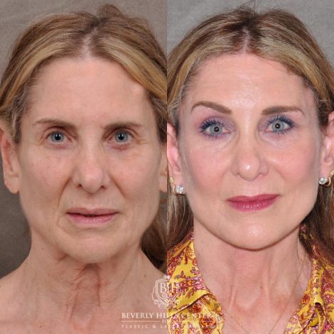 Beverly Hills Center Female Patient Before and After Auralyft, Eyes & Brows, Face & Neck