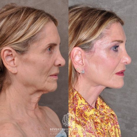 Beverly Hills Center Female Patient Before and After Auralyft, Eyes & Brows, Face & Neck