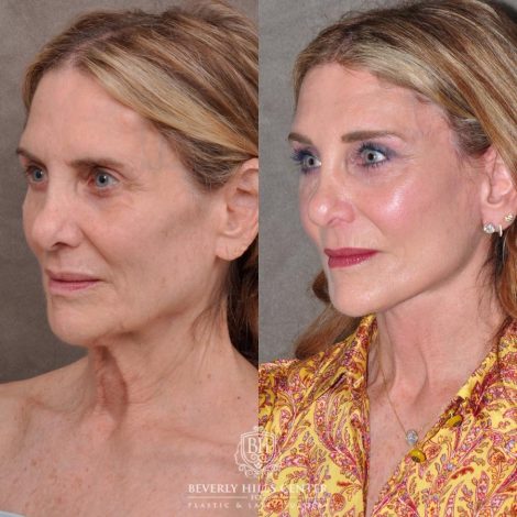 Beverly Hills Center Female Patient Before and After Auralyft, Eyes & Brows, Face & Neck