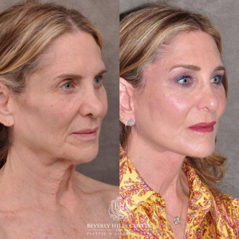 Beverly Hills Center Female Patient Before and After Auralyft, Eyes & Brows, Face & Neck