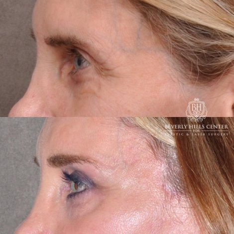 Beverly Hills Center Female Patient Before and After Auralyft, Eyes & Brows, Face & Neck