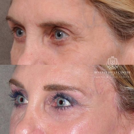 Beverly Hills Center Female Patient Before and After Auralyft, Eyes & Brows, Face & Neck