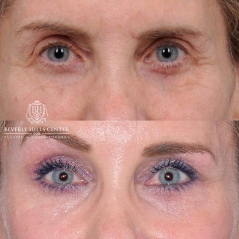 Beverly Hills Center Female Patient Before and After Auralyft, Eyes & Brows, Face & Neck