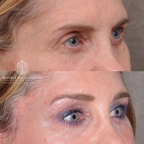 Beverly Hills Center Female Patient Before and After Auralyft, Eyes & Brows, Face & Neck