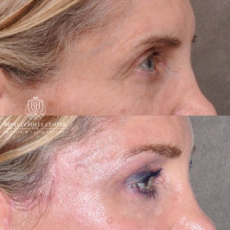 Beverly Hills Center Female Patient Before and After Auralyft, Eyes & Brows, Face & Neck