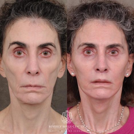 Beverly Hills Center Female Patient Before and After Auralyft, Eyes & Brows, Face & Neck and Lip Lift