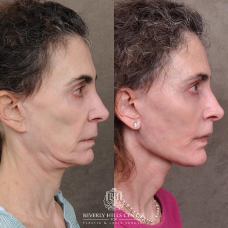 Beverly Hills Center Female Patient Before and After Auralyft, Eyes & Brows, Face & Neck and Lip Lift
