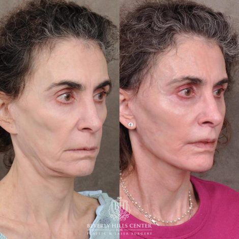 Beverly Hills Center Female Patient Before and After Auralyft, Eyes & Brows, Face & Neck and Lip Lift