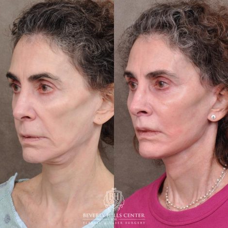 Beverly Hills Center Female Patient Before and After Auralyft, Eyes & Brows, Face & Neck and Lip Lift
