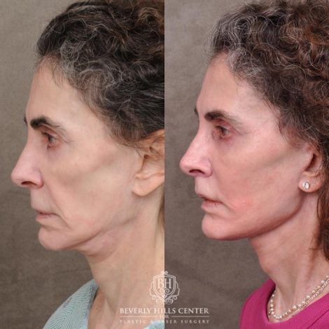 Beverly Hills Center Female Patient Before and After Auralyft, Eyes & Brows, Face & Neck and Lip Lift