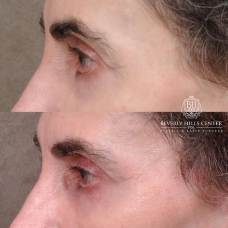 Beverly Hills Center Female Patient Before and After Auralyft, Eyes & Brows, Face & Neck and Lip Lift