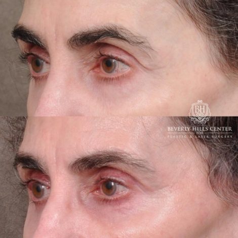 Beverly Hills Center Female Patient Before and After Auralyft, Eyes & Brows, Face & Neck and Lip Lift