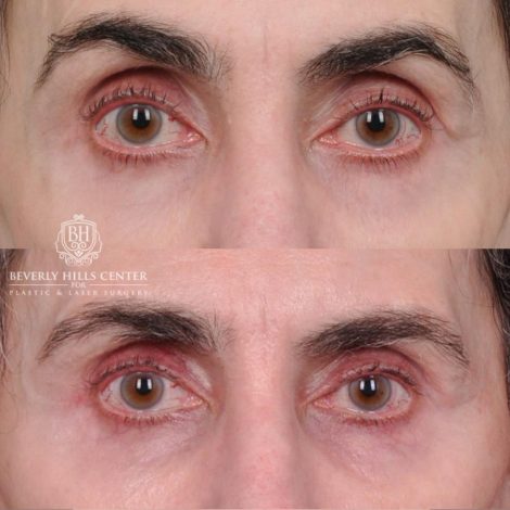 Beverly Hills Center Female Patient Before and After Auralyft, Eyes & Brows, Face & Neck and Lip Lift