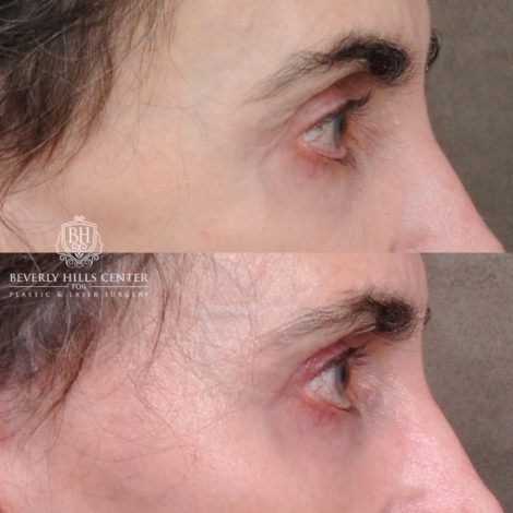 Beverly Hills Center Female Patient Before and After Auralyft, Eyes & Brows, Face & Neck and Lip Lift