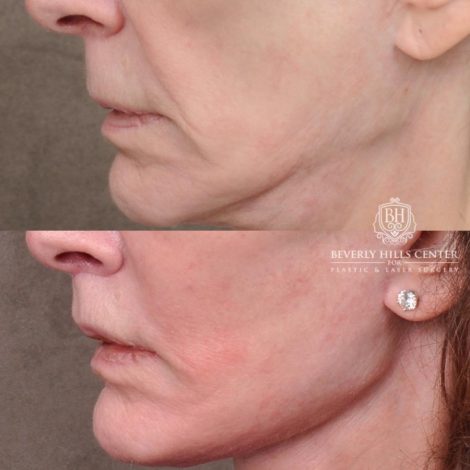 Beverly Hills Center Female Patient Before and After Auralyft, Eyes & Brows, Face & Neck and Lip Lift