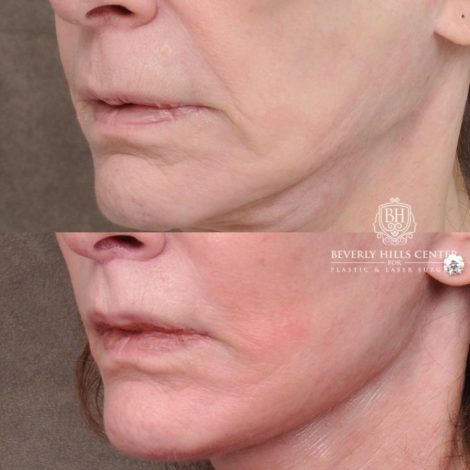 Beverly Hills Center Female Patient Before and After Auralyft, Eyes & Brows, Face & Neck and Lip Lift