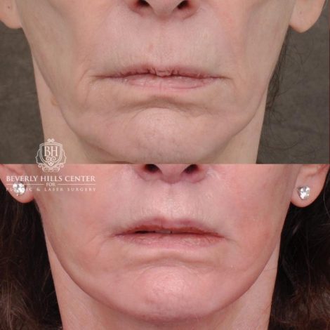 Beverly Hills Center Female Patient Before and After Auralyft, Eyes & Brows, Face & Neck and Lip Lift