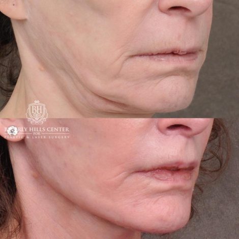 Beverly Hills Center Female Patient Before and After Auralyft, Eyes & Brows, Face & Neck and Lip Lift