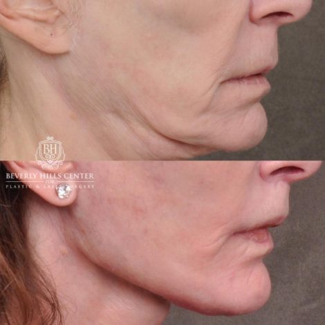 Beverly Hills Center Female Patient Before and After Auralyft, Eyes & Brows, Face & Neck and Lip Lift
