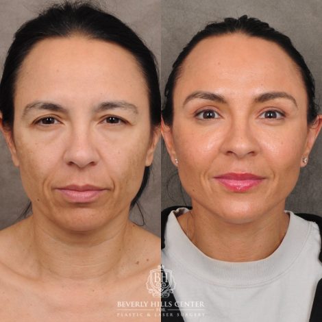 Beverly Hills Center Female Patient Before and After AuraLyft™, Temporal Brow Reset, Lower Blepharoplasty with Fat Repositioning, Ptosis Repair, Fat Grafting