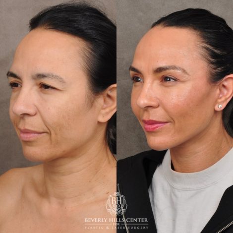 Beverly Hills Center Female Patient Before and After AuraLyft™, Temporal Brow Reset, Lower Blepharoplasty with Fat Repositioning, Ptosis Repair, Fat Grafting
