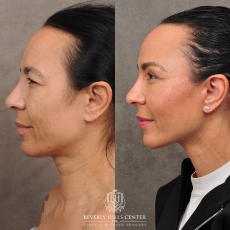 Beverly Hills Center Female Patient Before and After AuraLyft™, Temporal Brow Reset, Lower Blepharoplasty with Fat Repositioning, Ptosis Repair, Fat Grafting