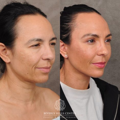 Beverly Hills Center Female Patient Before and After AuraLyft™, Temporal Brow Reset, Lower Blepharoplasty with Fat Repositioning, Ptosis Repair, Fat Grafting