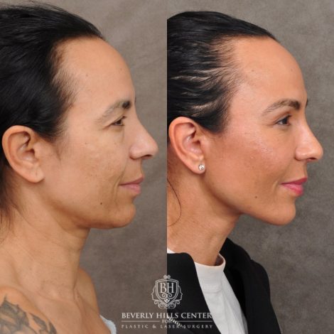 Beverly Hills Center Female Patient Before and After AuraLyft™, Temporal Brow Reset, Lower Blepharoplasty with Fat Repositioning, Ptosis Repair, Fat Grafting